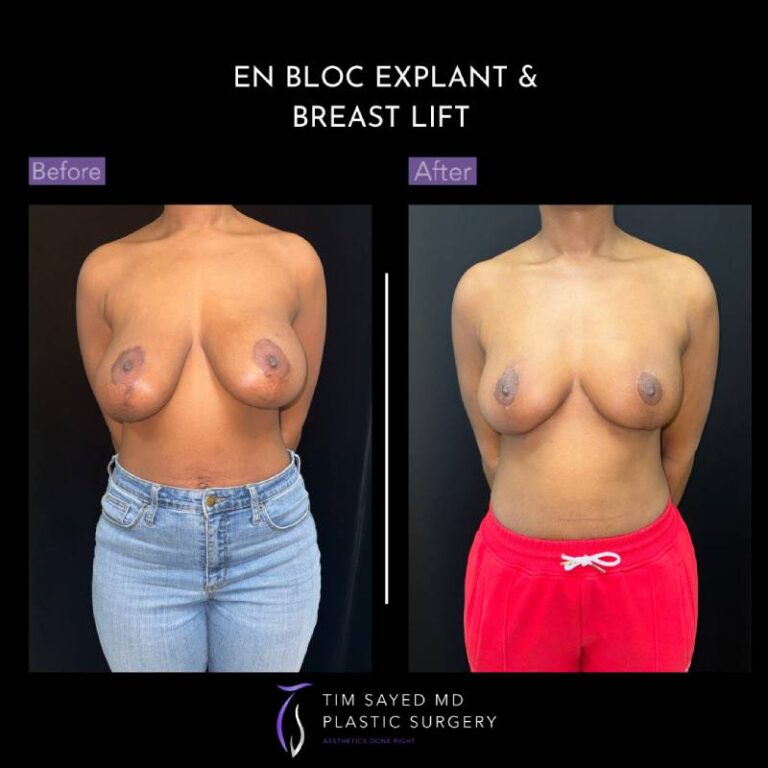 before and after en bloc explant with mastopexy front view of patient 8751