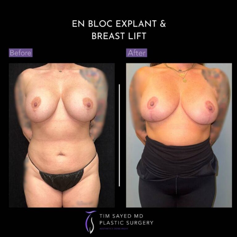 before and after en bloc explant with mastopexy front view of patient 8754