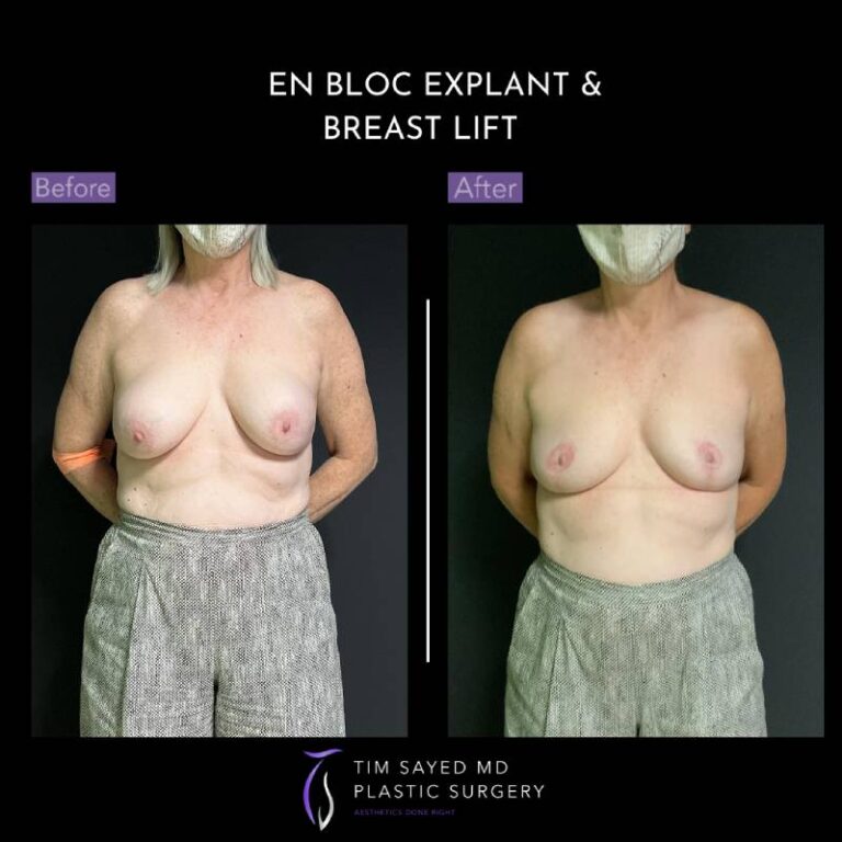before and after en bloc explant with mastopexy front view of patient 8776