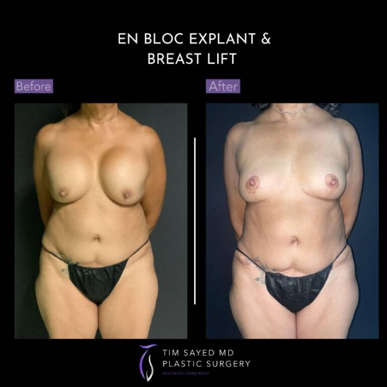 before and after en bloc explant with mastopexy front view of patient 8808