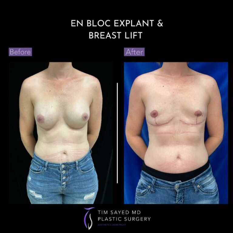 before and after en bloc explant with mastopexy front view of patient 8828