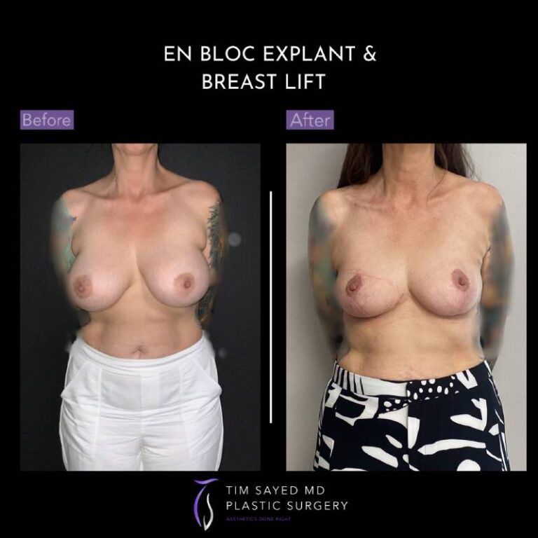 before and after en bloc explant with mastopexy front view of patient 8865