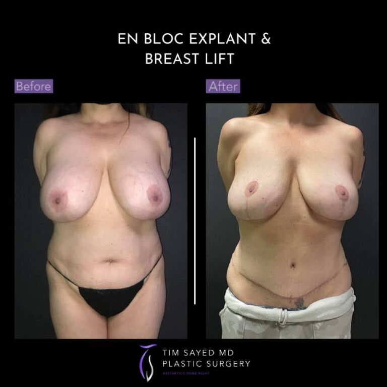 before and after front view en bloc breast implant removal with mastopexy case 8947