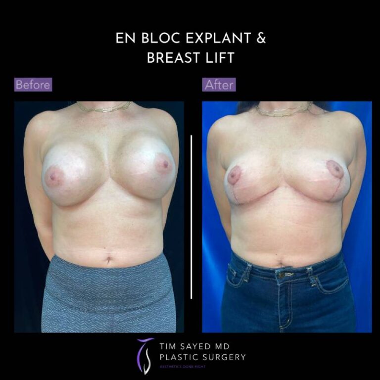 before and after front view en bloc breast implant removal with mastopexy case 8972