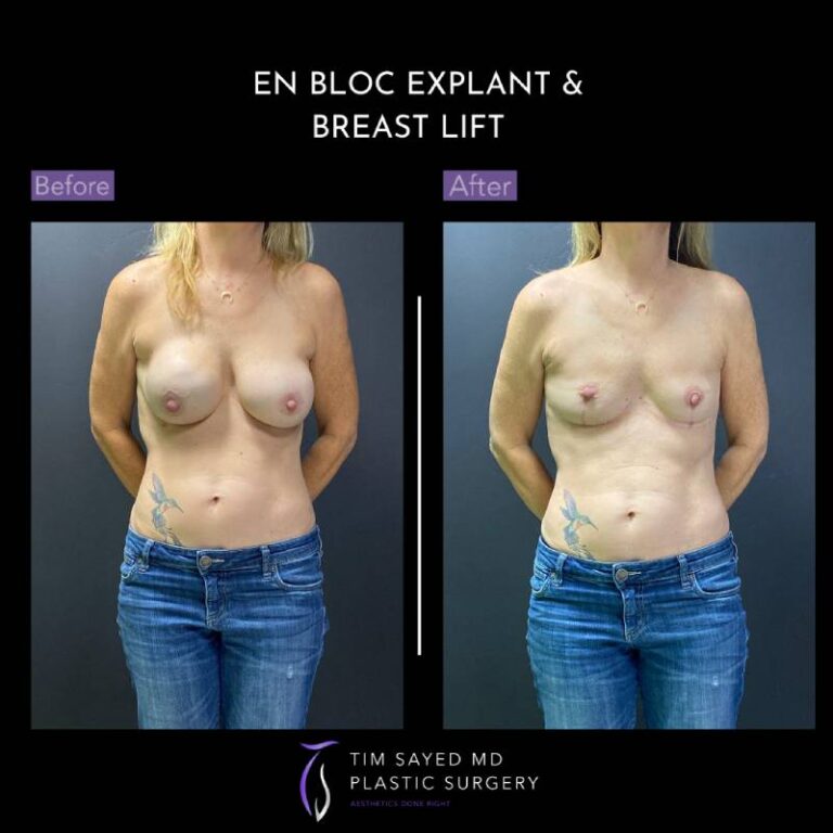 before and after front view en bloc breast implant removal with mastopexy case 8975