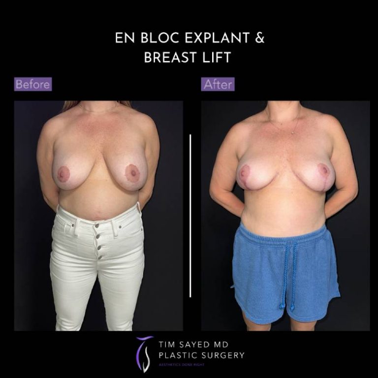 before and after front view en bloc breast implant removal with mastopexy case 9038