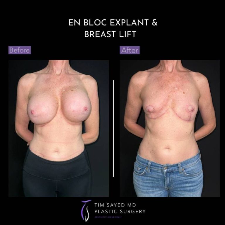 before and after front view en bloc breast implant removal with mastopexy case 9052