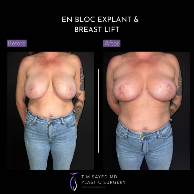before and after front view en bloc breast implant removal with mastopexy case 9086