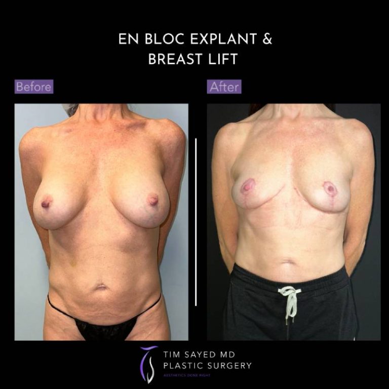 before and after front view en bloc breast implant removal with mastopexy case 9092