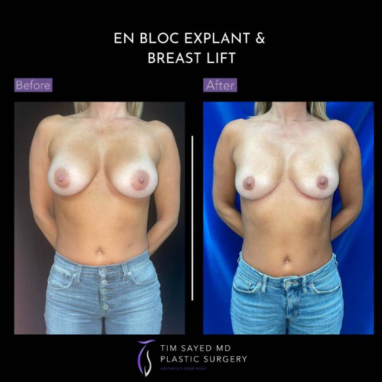 before and after front view en bloc breast implant removal with mastopexy case 9095