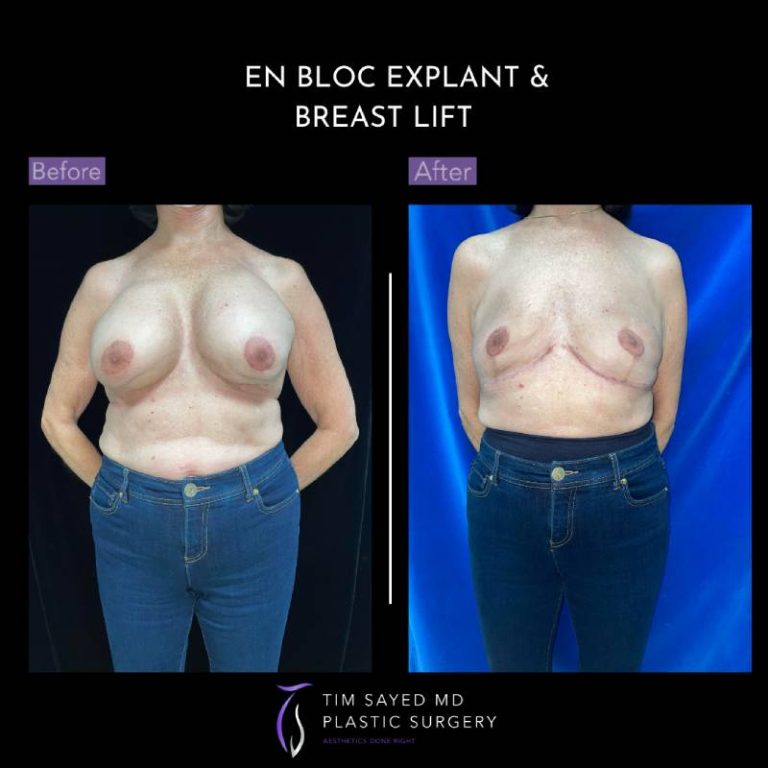before and after front view en bloc breast implant removal with mastopexy case 9098