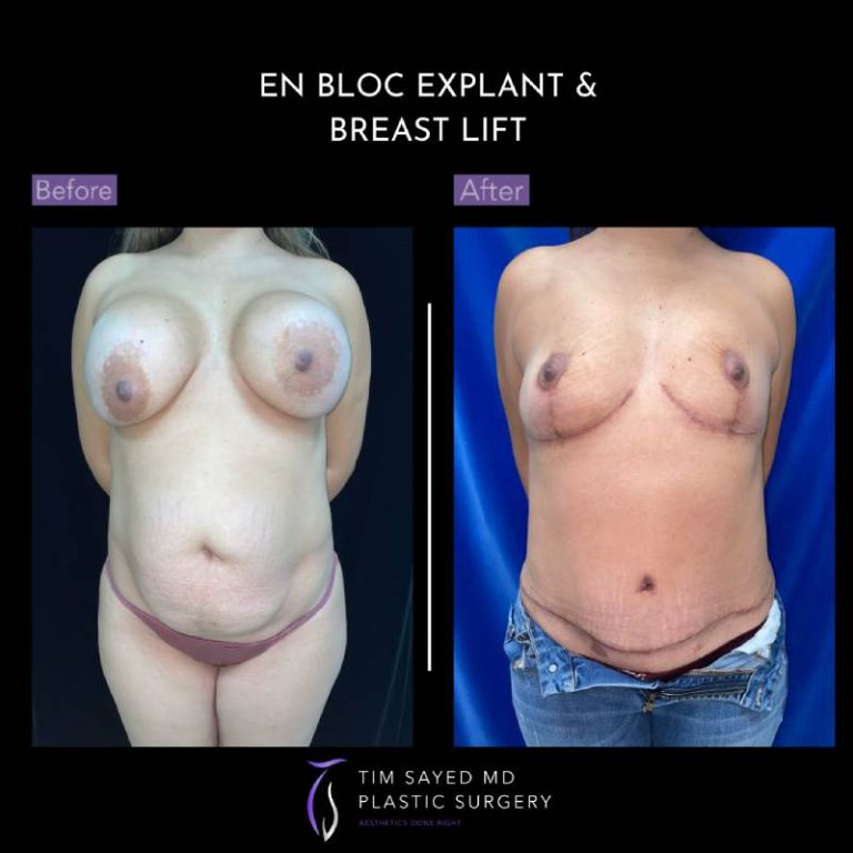 before and after front view en bloc breast implant removal with mastopexy case 9101