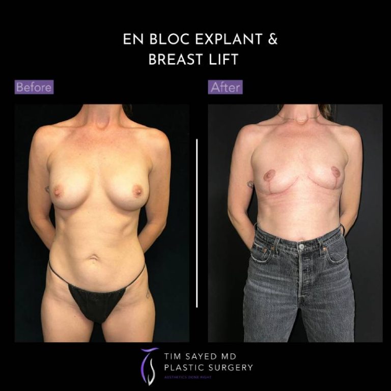 before and after front view en bloc breast implant removal with mastopexy case 9104