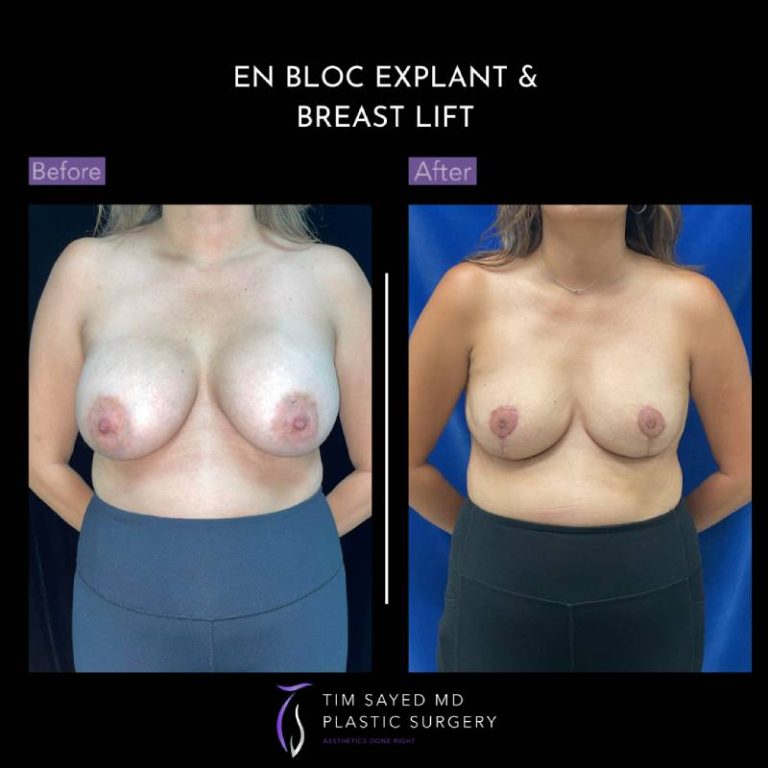 before and after front view en bloc breast implant removal with mastopexy case 9107