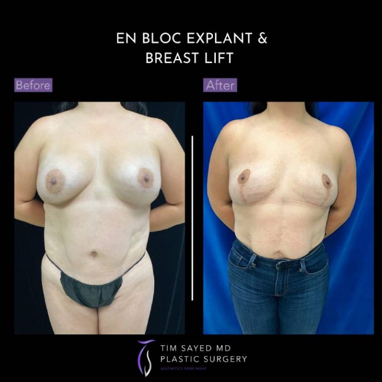 before and after front view en bloc breast implant removal with mastopexy case 9110