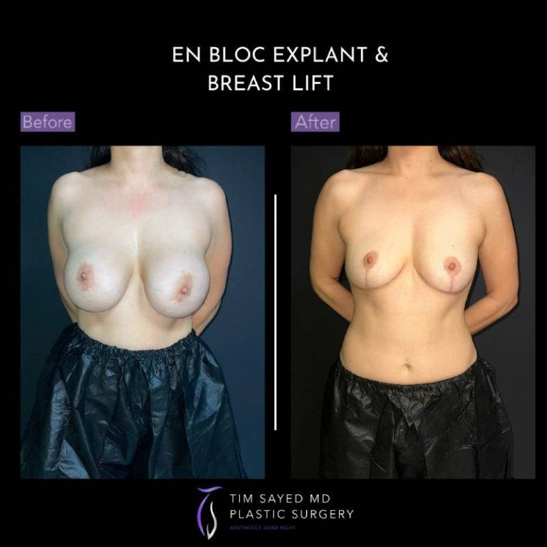 before and after front view en bloc breast implant removal with mastopexy case 9115