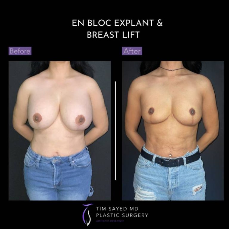 before and after front view en bloc breast implant removal with mastopexy case 9119