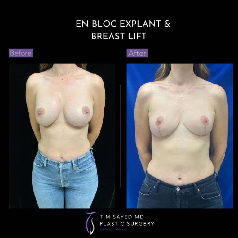 before and after front view en bloc breast implant removal with mastopexy case 9122