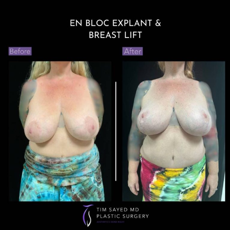 before and after front view en bloc breast implant removal with mastopexy case 9124