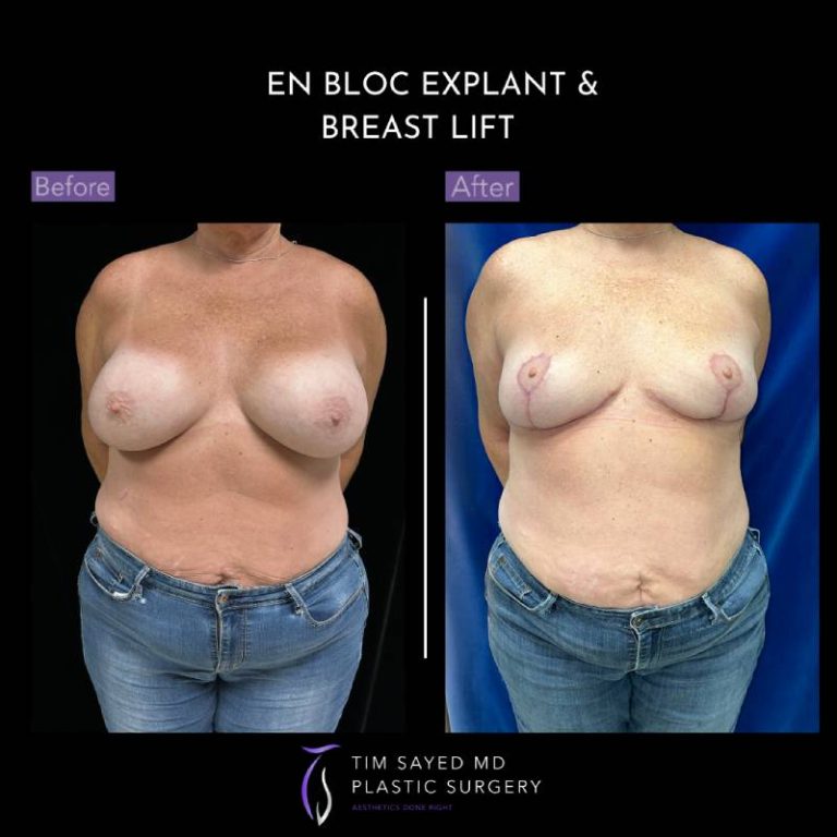 before and after front view en bloc breast implant removal with mastopexy case 9126