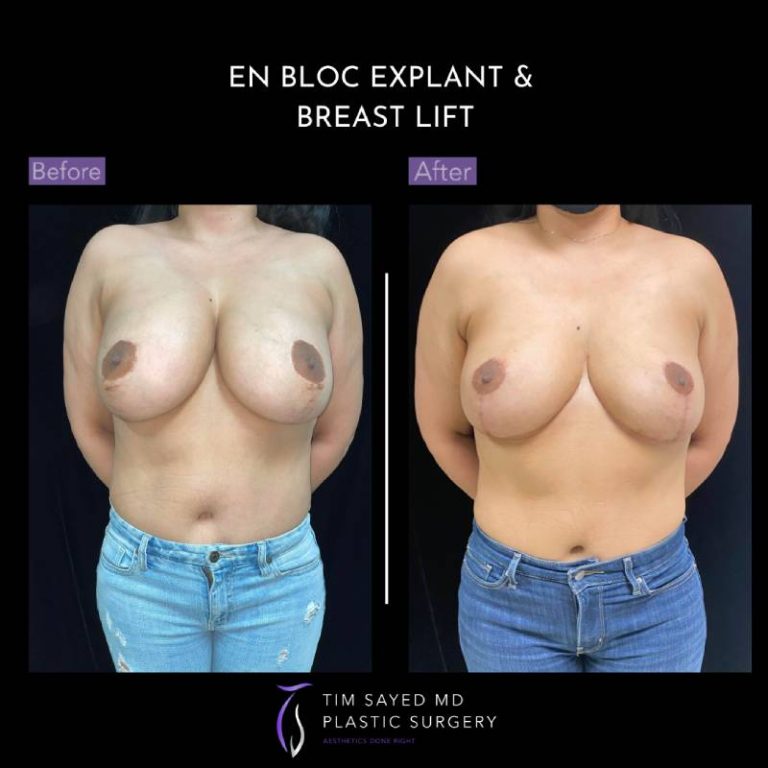 before and after front view en bloc breast implant removal with mastopexy case 9129