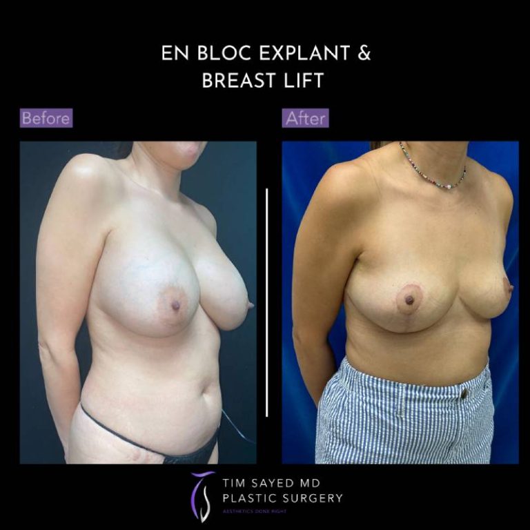 before and after right angle view en bloc breast implant removal with mastopexy case 9132